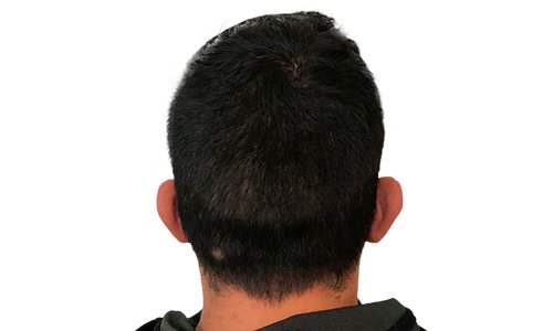 dopo un intervento chirurgico all'orecchio.